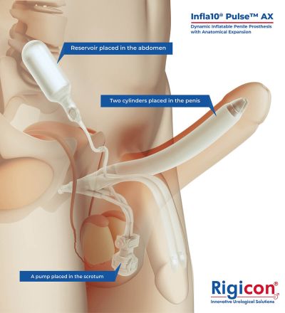 Infla10® Pulse™ AX Dynamic Inflatable Penile Prosthesis Product Illustration