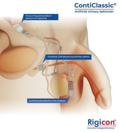 ContiClassic<sup>®</sup> Artificial Urinary Sphincter Product Illustration